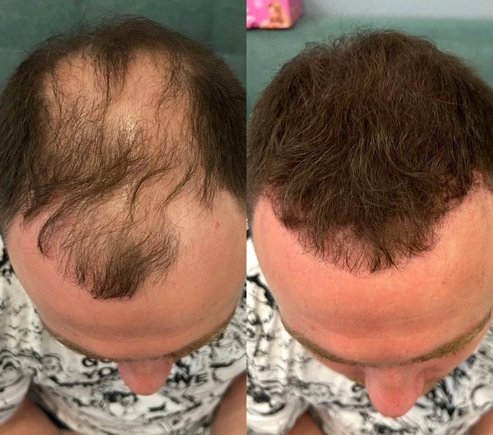 Before and after comparison of hair growth on a person's head.